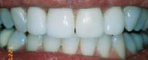 Porcelain Veneers & Bridge Work After