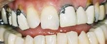 Porcelain Veneers & Bridge Work Before