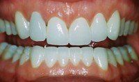 Porcelain Veneers & Crowns After