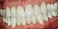 Porcelain Veneers & Crowns After