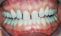 Porcelain Veneers & Crowns Before