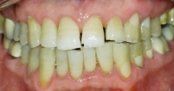 Porcelain Veneers & Crowns Before