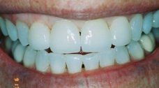 Porcelain Veneers After