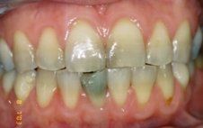 Porcelain Veneers Before