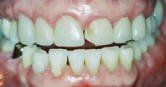 Porcelain Veneers Before