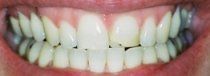 Porcelain Veneers Before