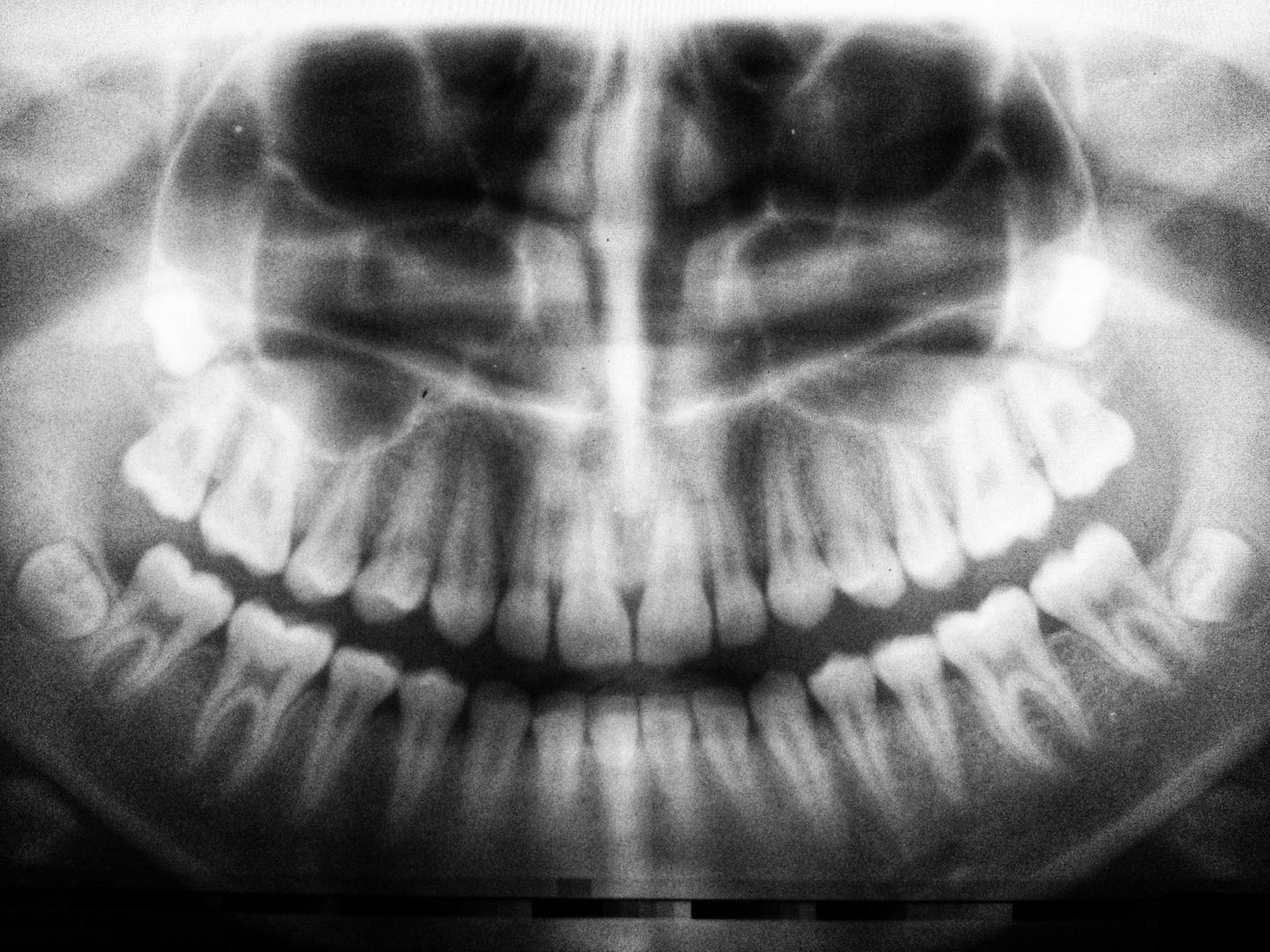 Teeth Sealants